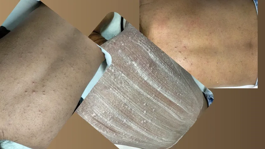 Depilación Espalda o Pecho