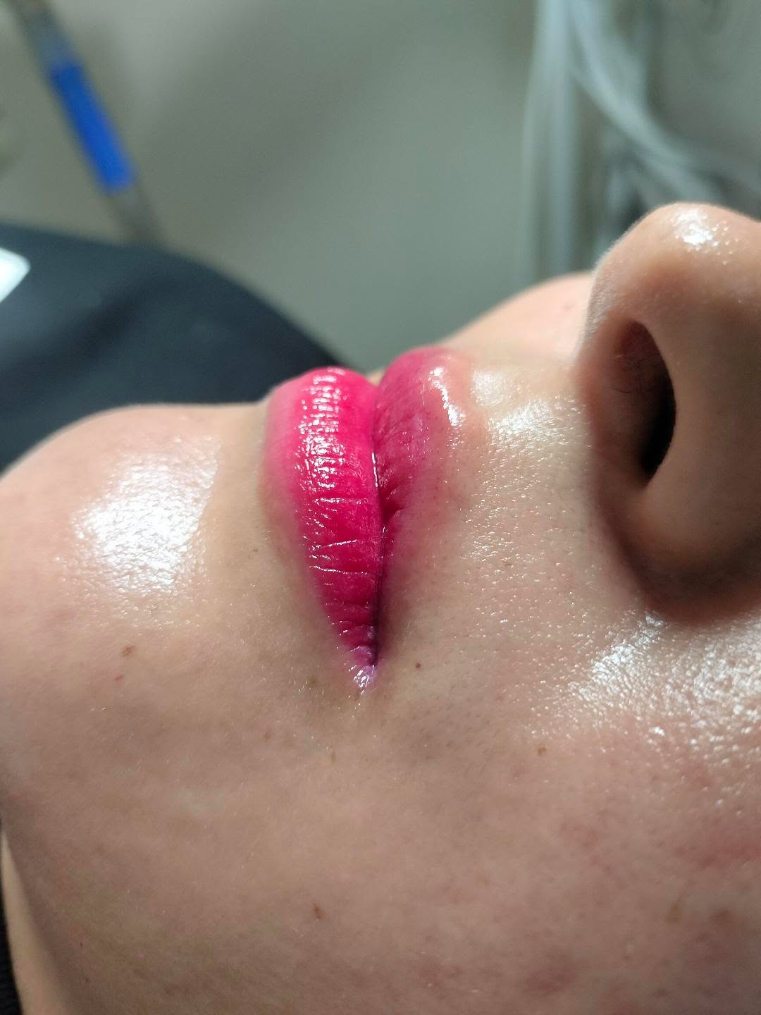 Hidra Lips