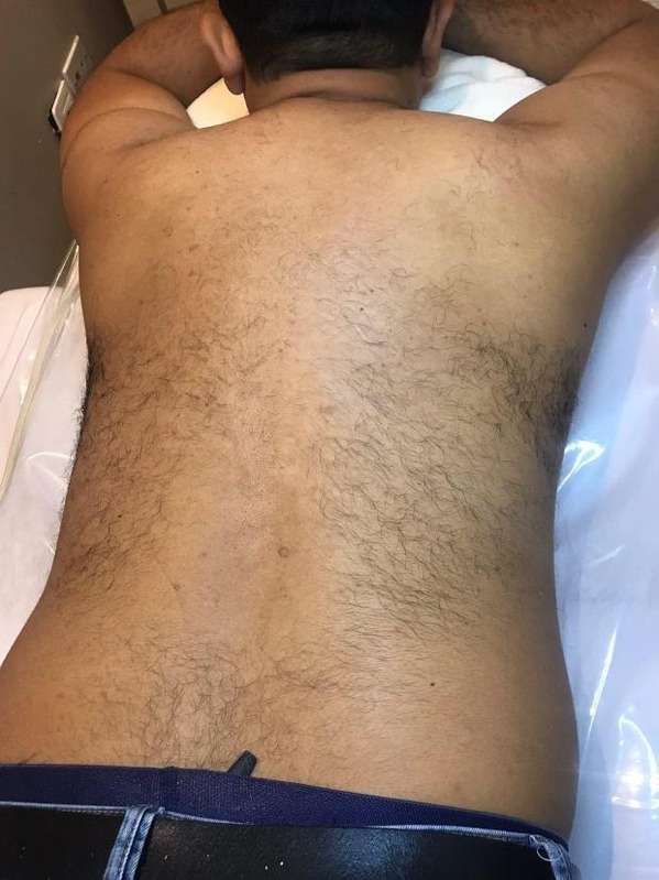 Antes Depilación con Cera